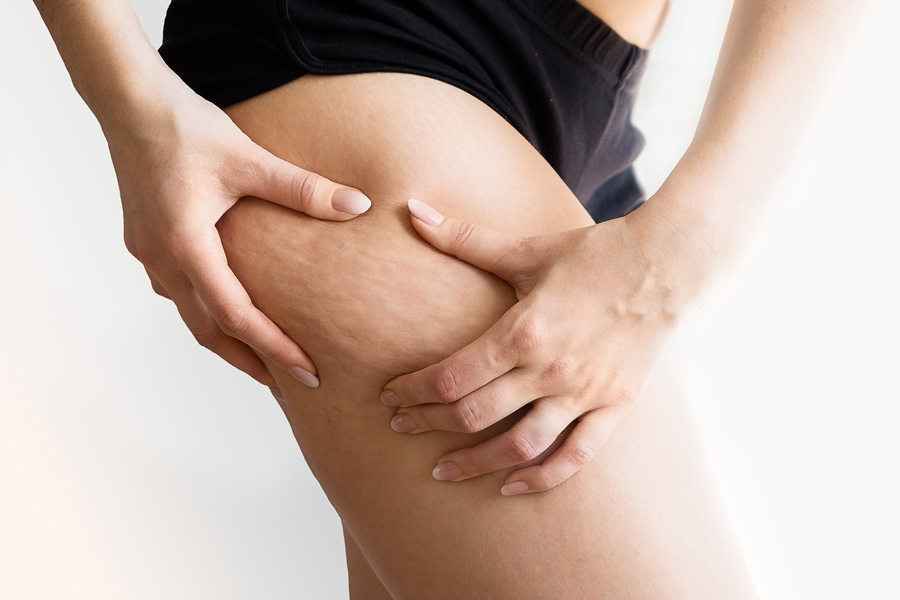 cellulite-donna - Stai Bene Cosmetica