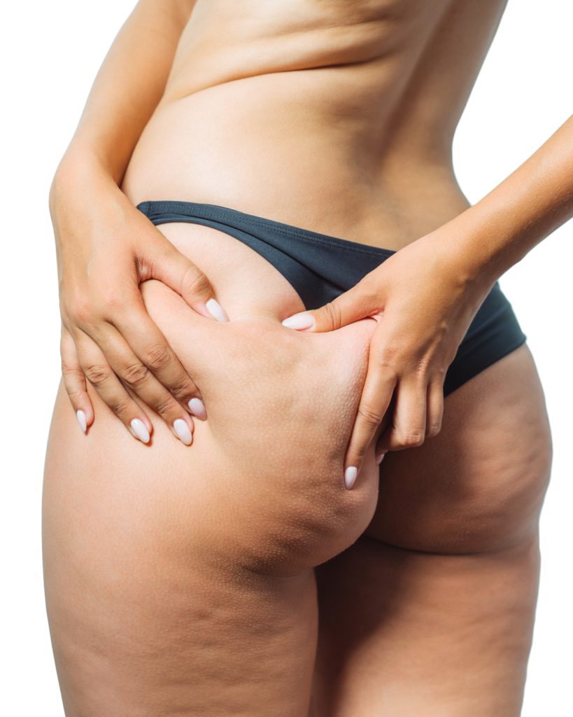 Donna-con-cellulite